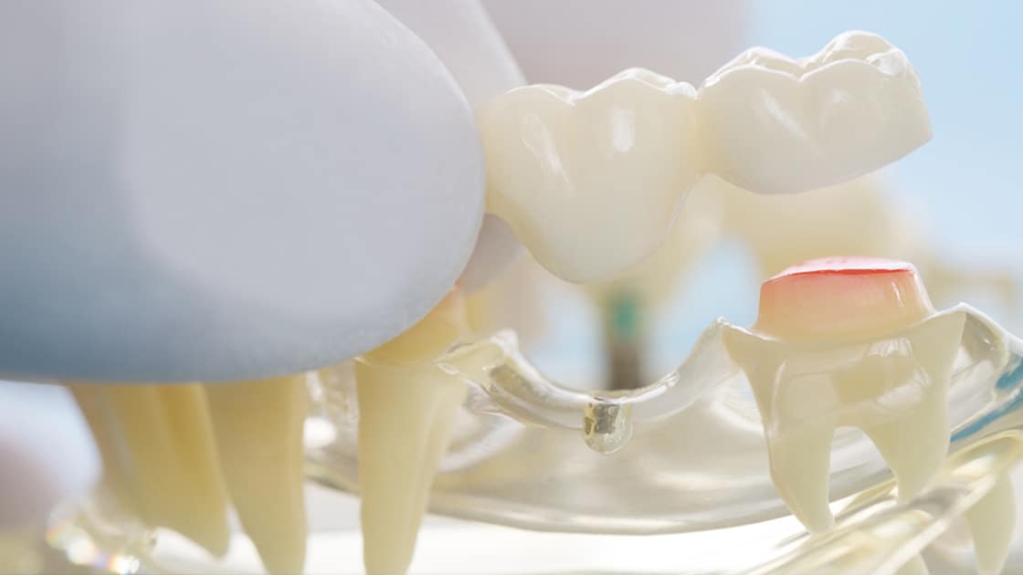 New Dental Bridge Photo