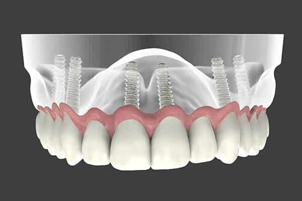 Implant Supported Dentures