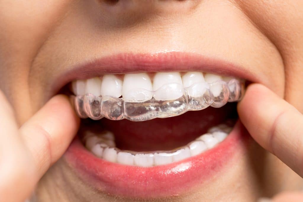 Can Invisalign Fix an Underbite?