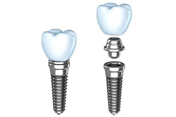 Single Dental Implant