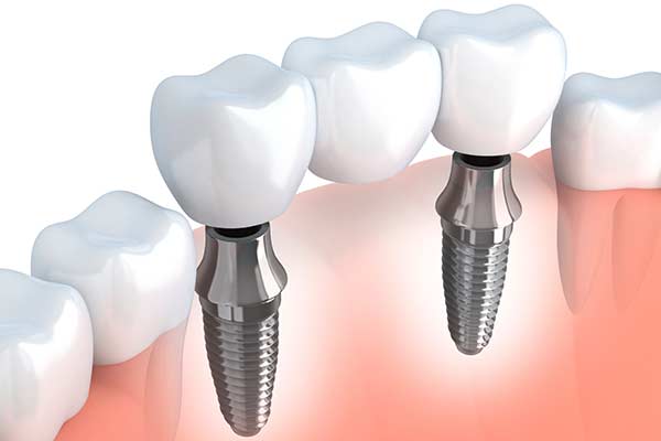 Implant- Supported Bridge Photo