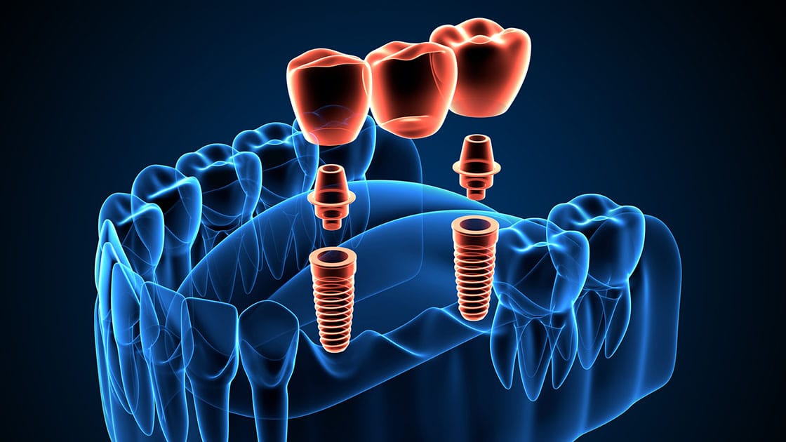 Fluoride Treatment