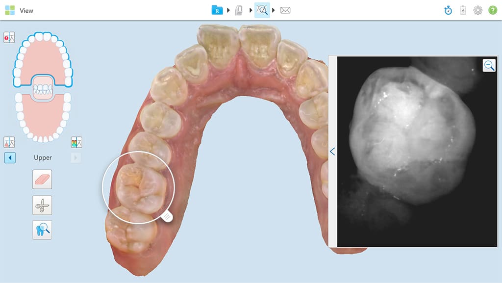 Itero Scanning Image