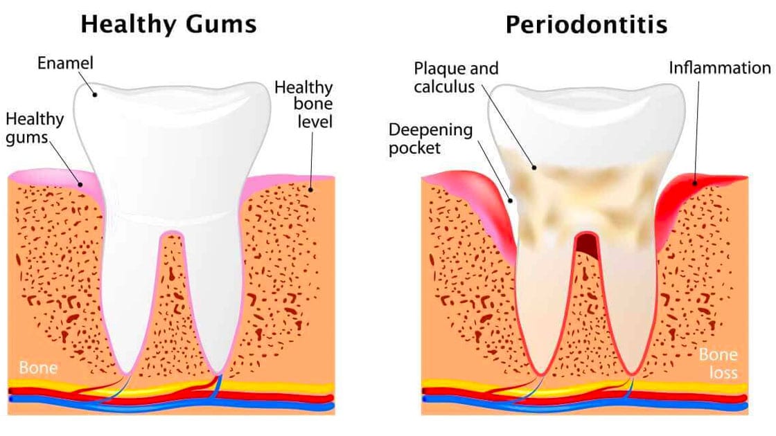 Peridontal Disease Illustration